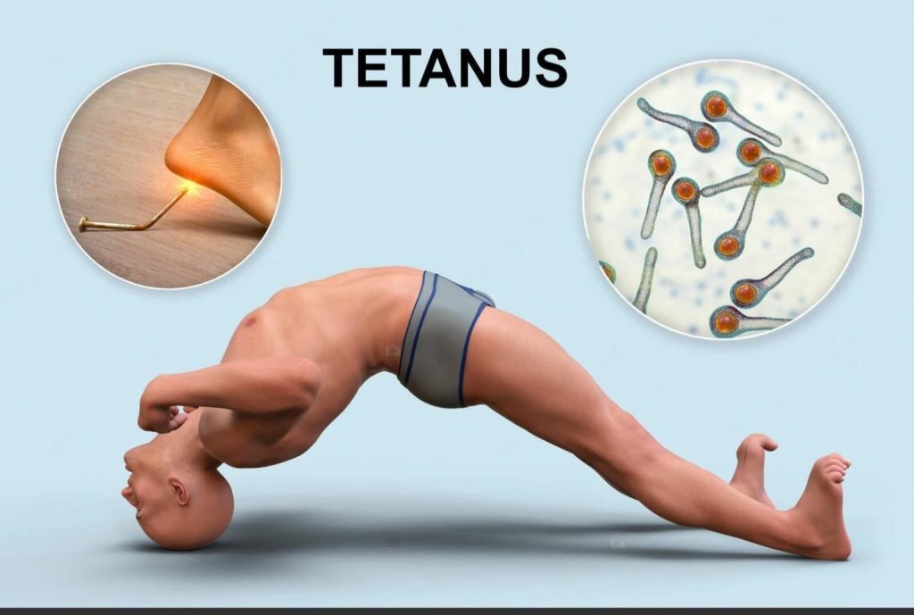 tetanus