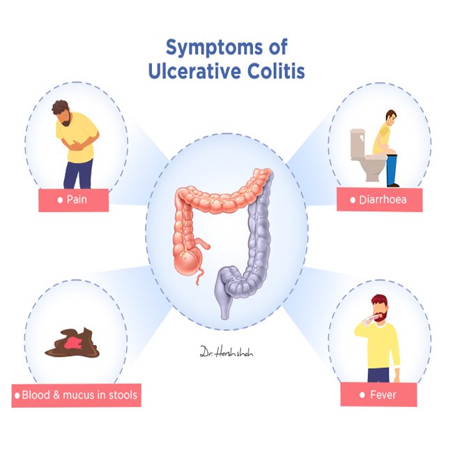 Ulcerative colitis 