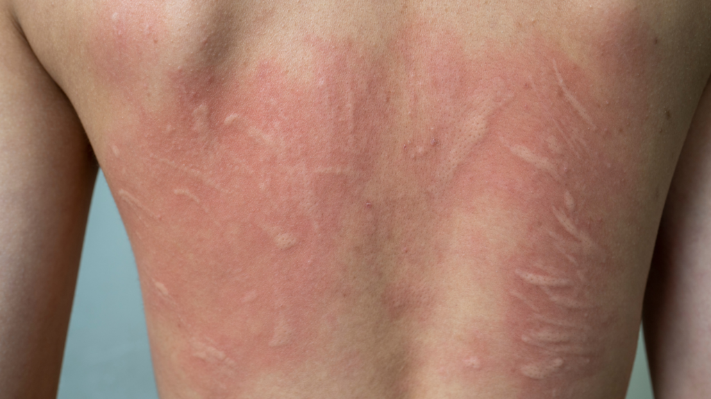 Urticaria
