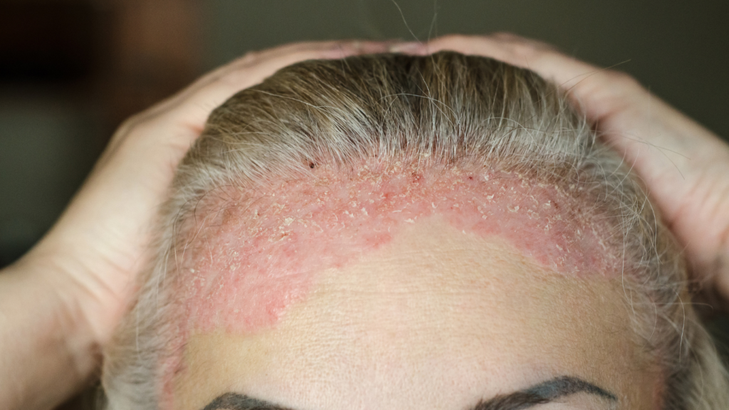 Eczema