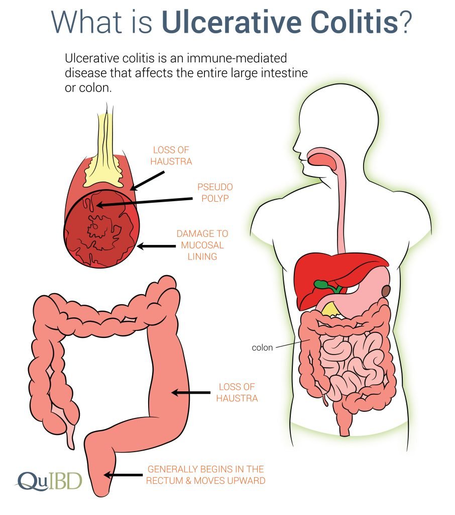Ulcerative colitis 