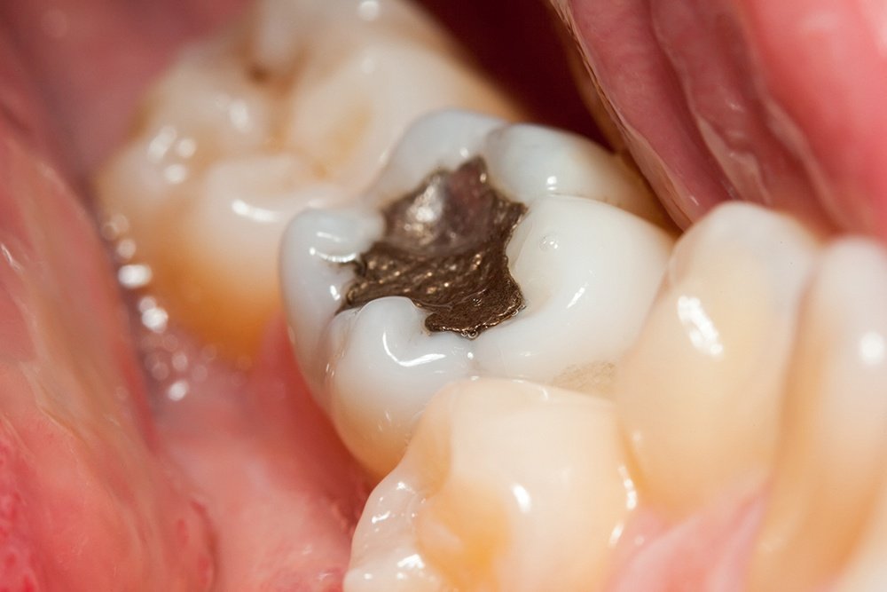 DENTAL CARIES