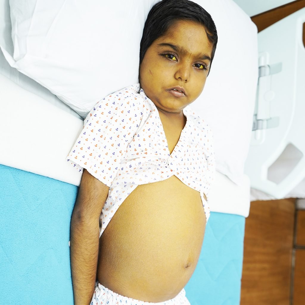 Infantile liver cirrhosis