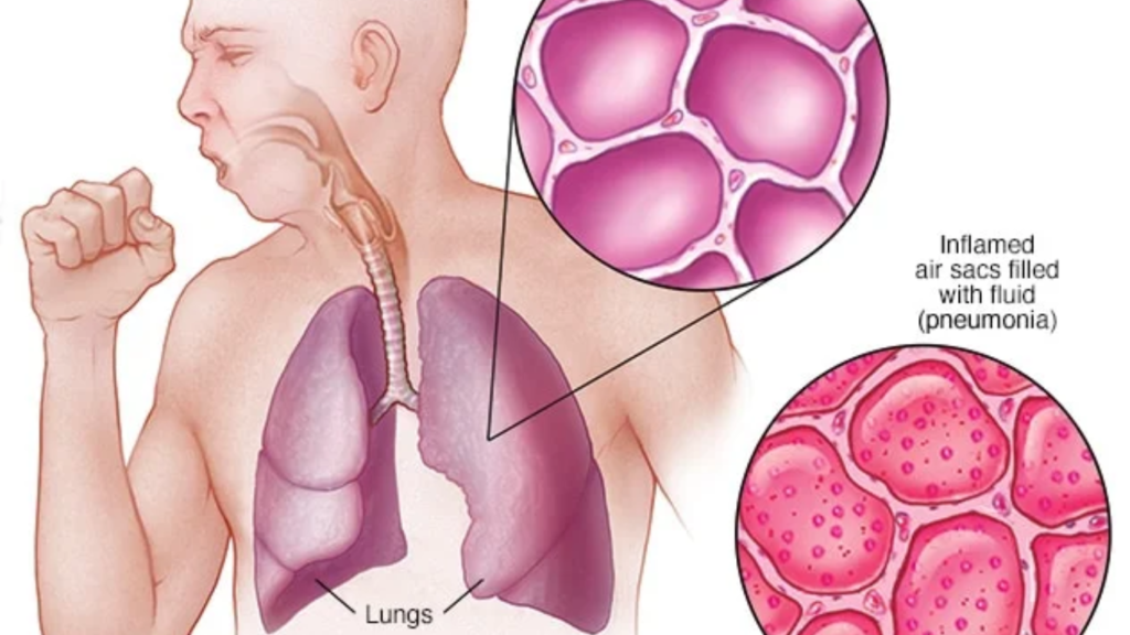 Pneumonia