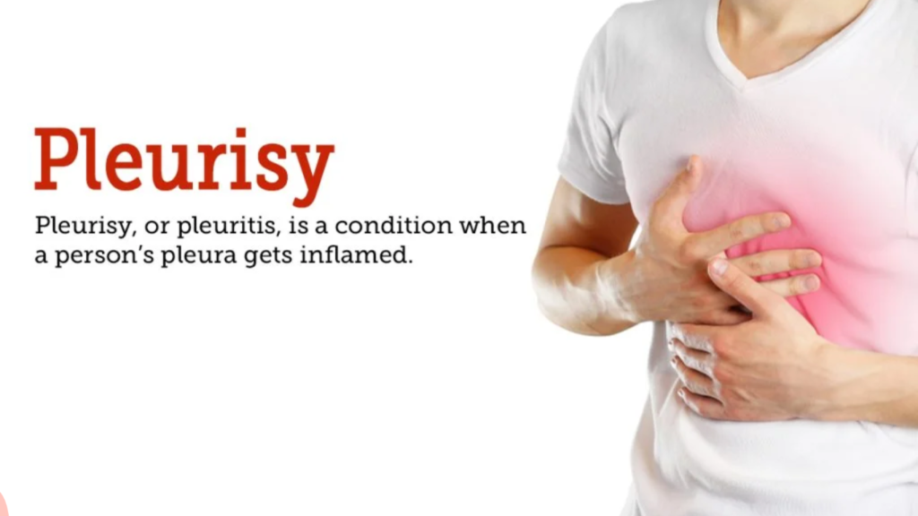 Pleurisy