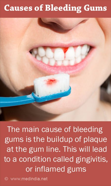Bleeding gums