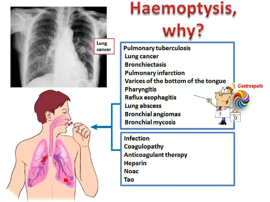 Haemoptysis