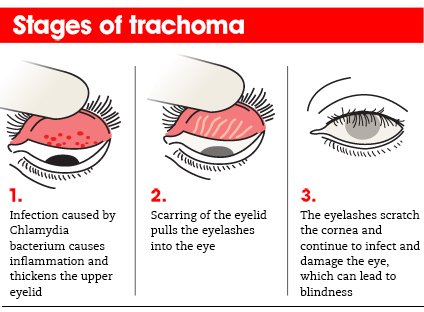 Trachoma