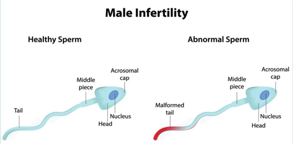 Infertility