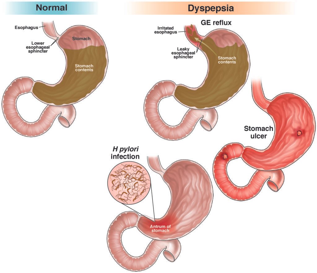 Normal & Dyspesia 