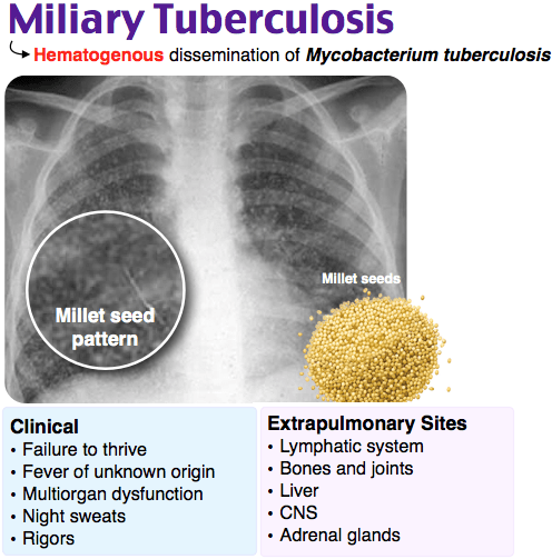 MILIARY TUBERCULOSIS