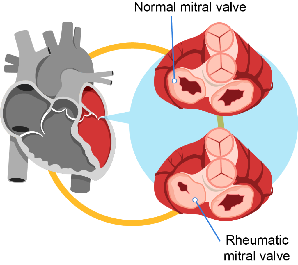 Rheumatic Fever