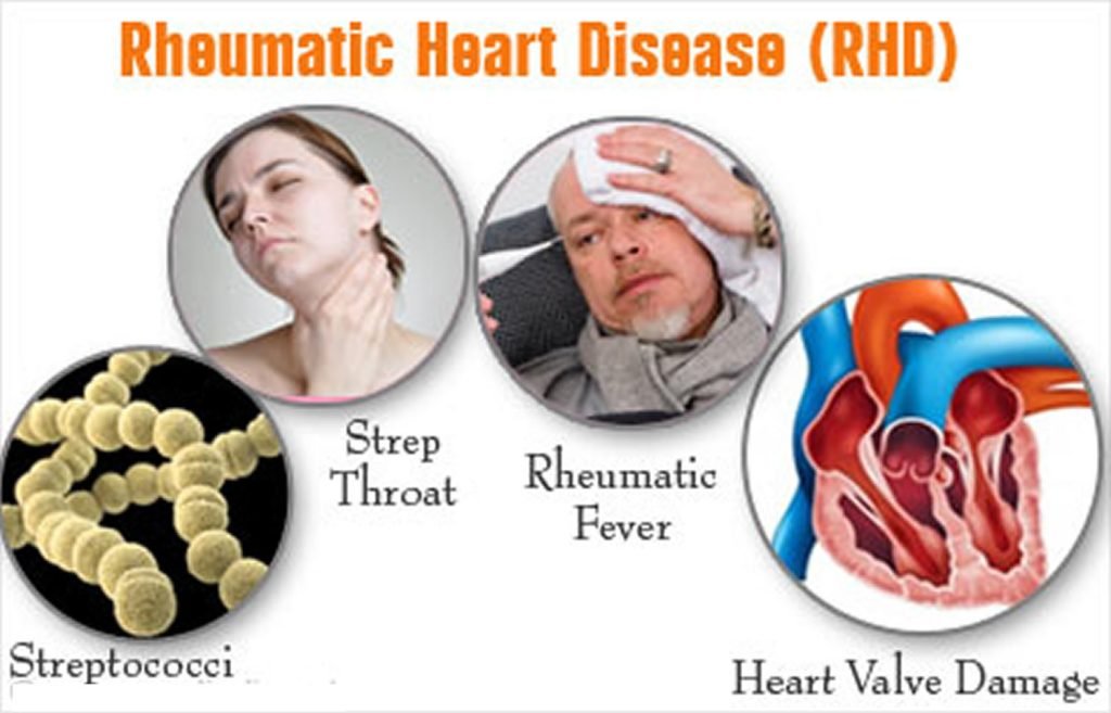 Rheumatic Fever