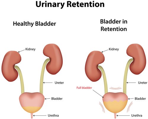 RETENTION OF URINE