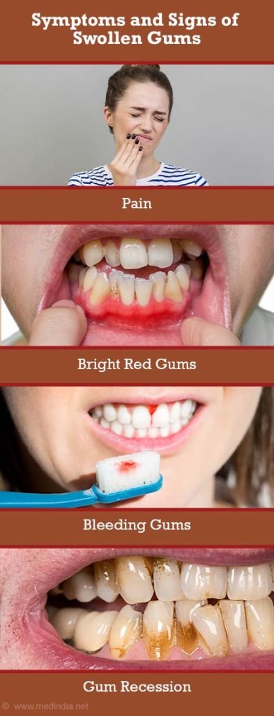 Bleeding gums