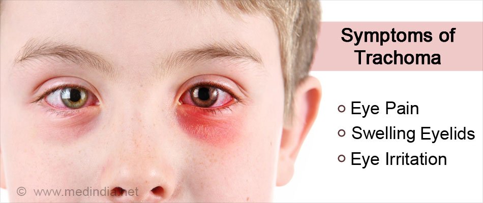 Trachoma