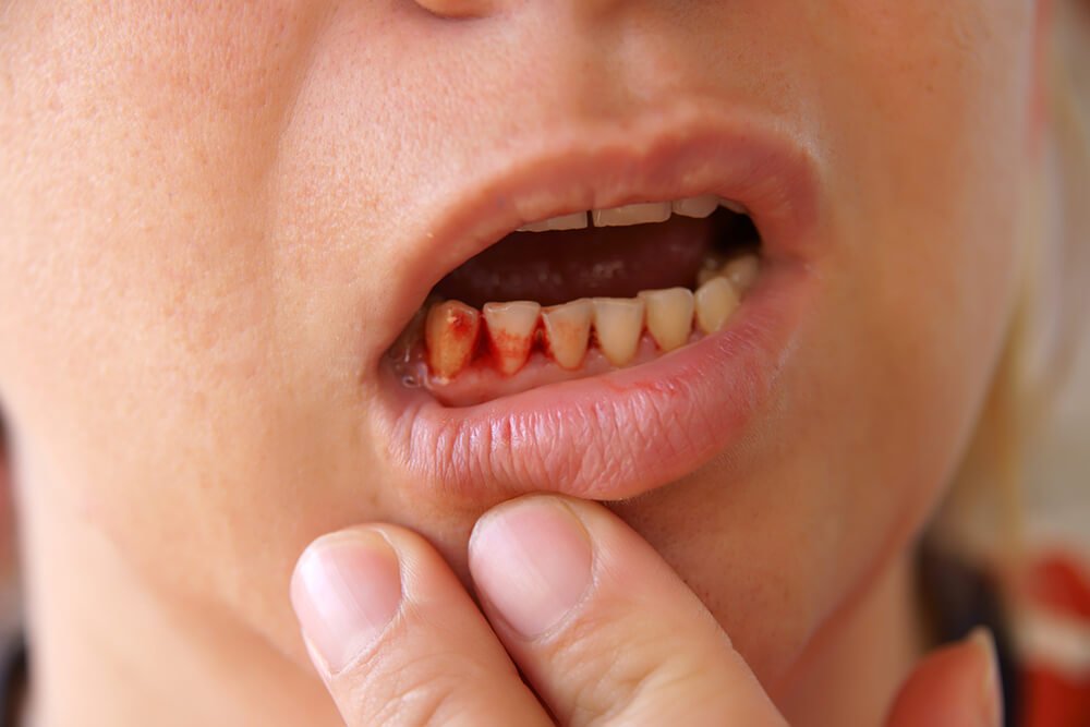 Bleeding gums
