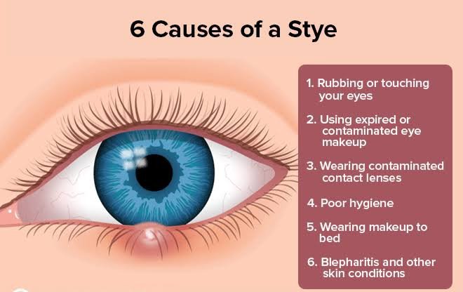 stye