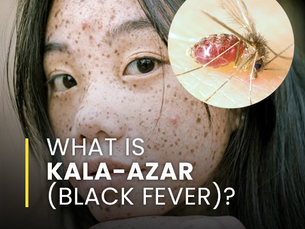 Kala-azar
