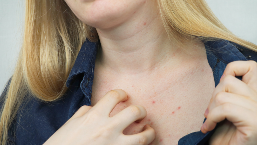 Scabies