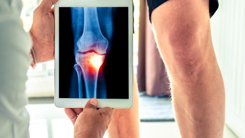 Osteoarthritis 