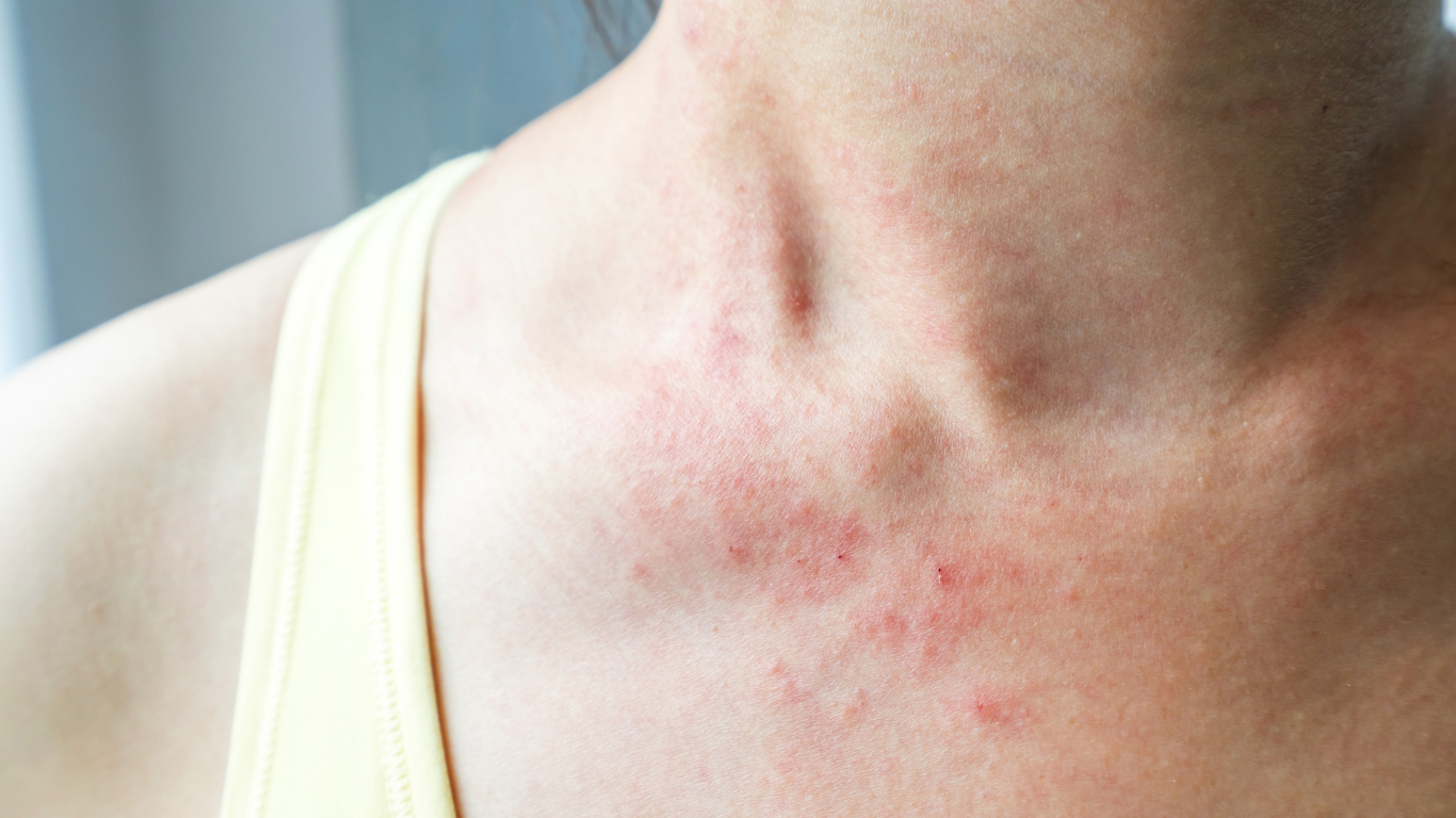 Eczema Treatment – एक्जिमा का असरदार इलाज