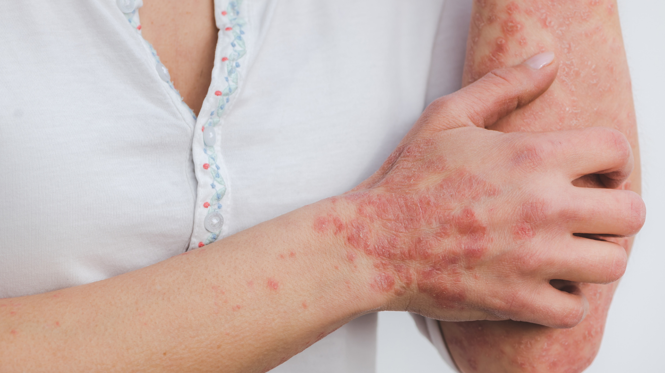 Psoriasis Treatment
