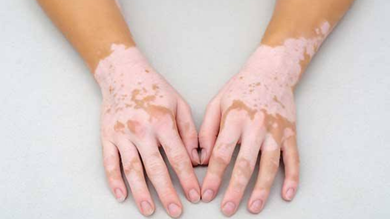 LEUCODERMA